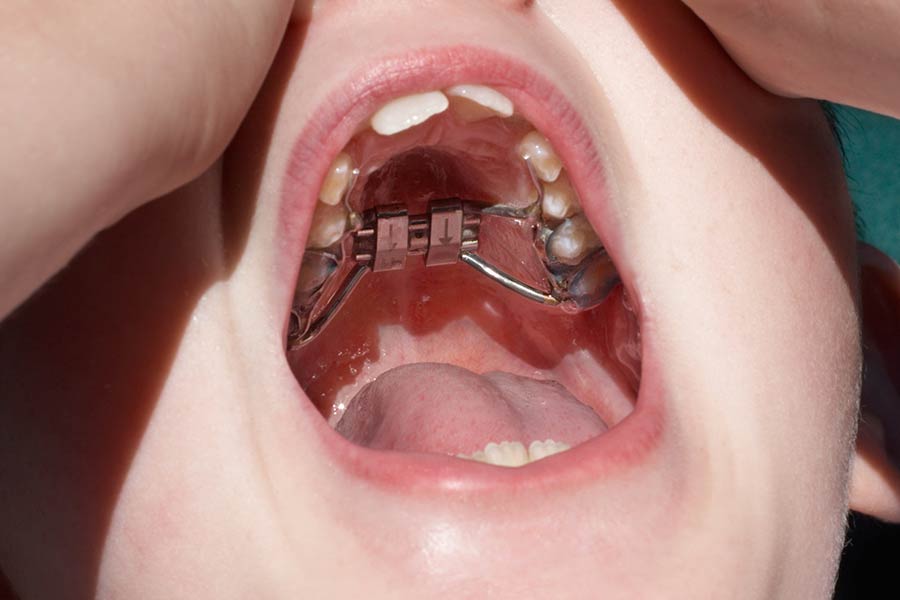 orthodontics palatal expander